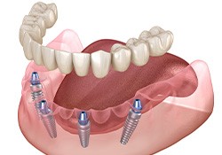 Rendering of dentures on 4 dental implants in lower jaw with white background