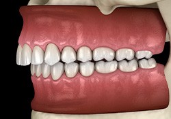 Illustration of an overbite