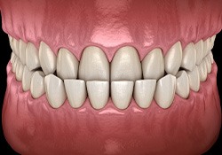 Illustration of an underbite