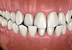 Illustration of a crossbite