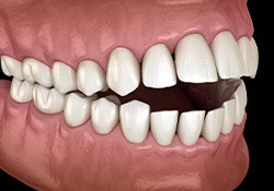 Illustration of an open bite