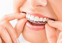 Up-close view of person inserting Invisalign aligner onto top teeth
