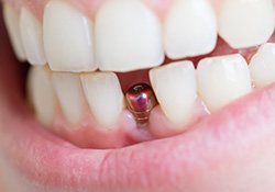 A closeup of a single tooth implant and its abutment