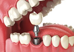 A closeup of a dental implant and its final restoration