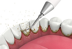 Illustration of scaler being used to clean teeth